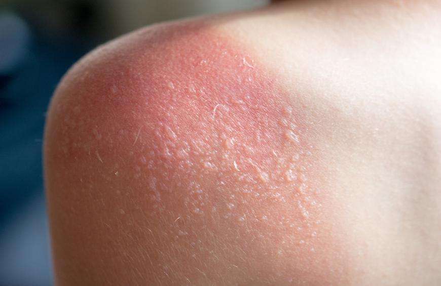 10 Signs You Might Have Sun Poisoning