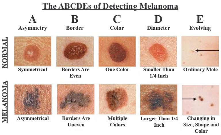 10 Skin Cancer Signs You Should Never Ignore