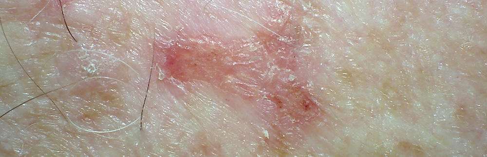 11 skin cancer symptoms you should never ignore