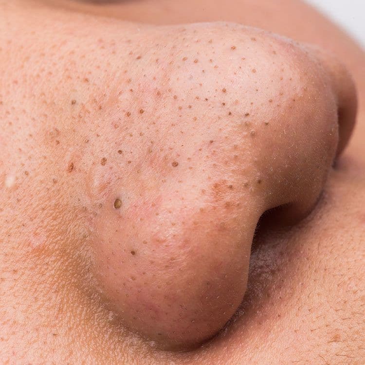 12 Bumps On Your Skin That Are Totally NormalAnd You Shouldn