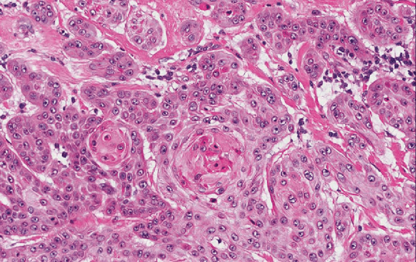 2 Moderately differentiated squamous cell carcinoma ...