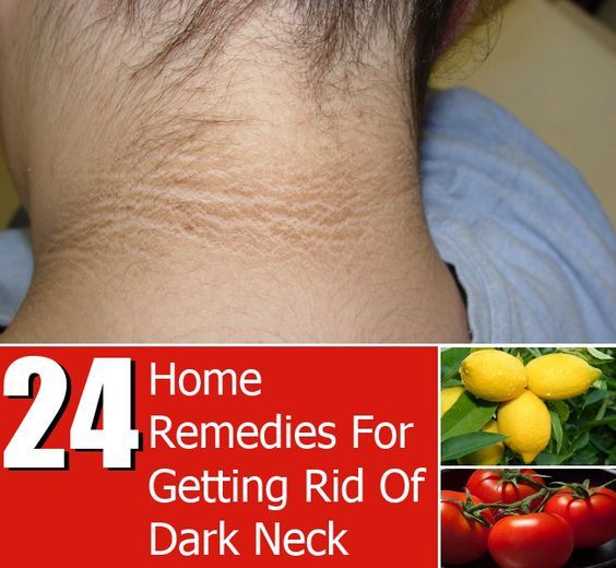 24 Home Remedies For Getting Rid Of Dark Neck
