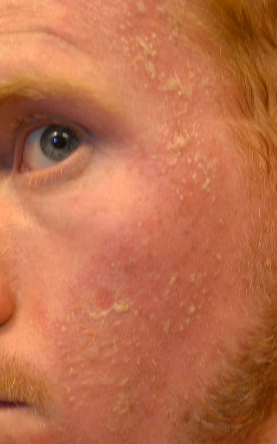 27 Years of Nothing but Failures: Fun with Skin Cancer Part 2!