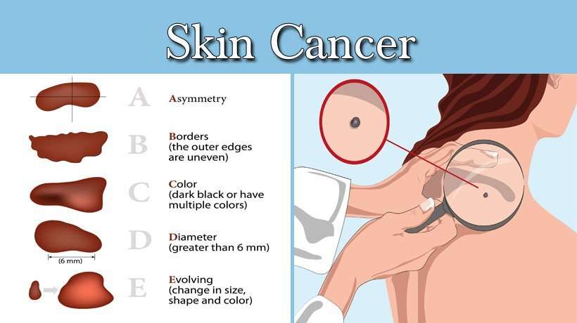 3 Types of Skin Cancer Women Need to Know About