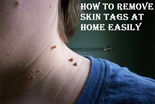 5 Great Ways to Remove Skin Tags