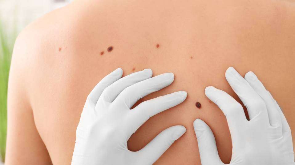 5 places you can surprisingly get skin cancer that arenât ...
