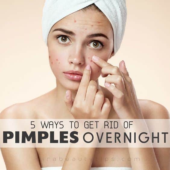5 Ways to Get Rid of Pimples Overnight