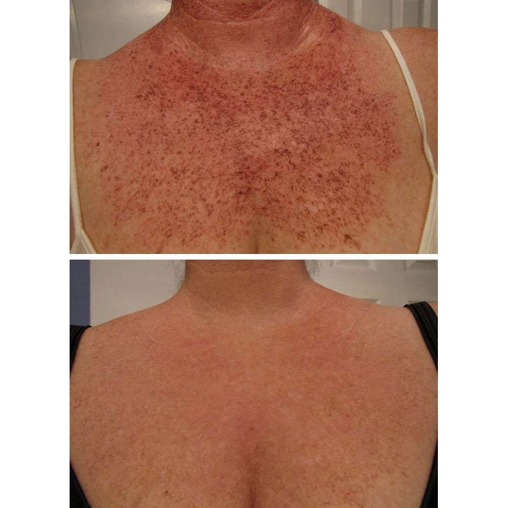 5 Ways to Treat Sunspots on Your Chest