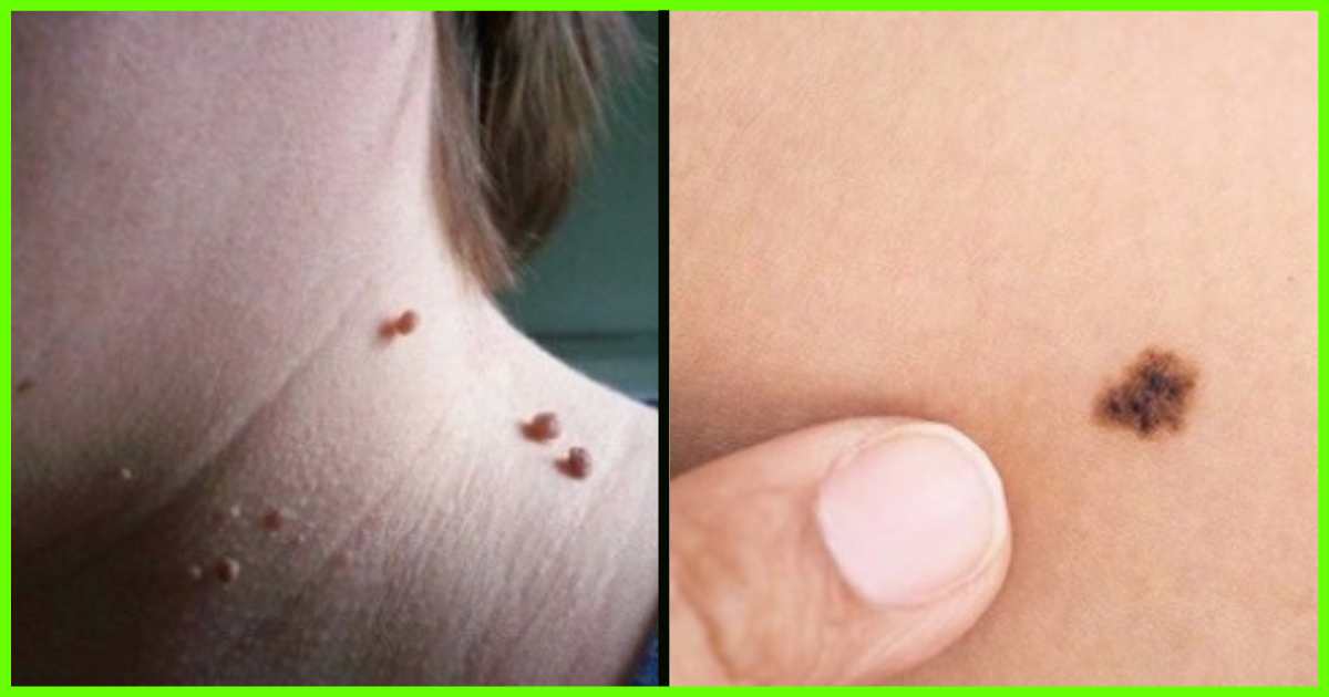6 Natural Ways To Help Get Rid Of Skin Tags, Spots, Moles ...