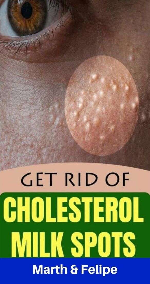 7 Remedies To Get Rid of Cholesterol Milk Spots Naturally ...