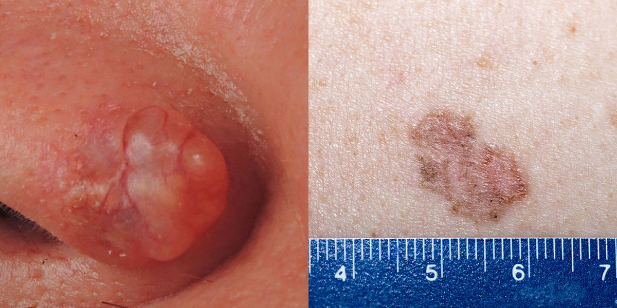 7 Skin Cancer Symptoms Besides New Moles