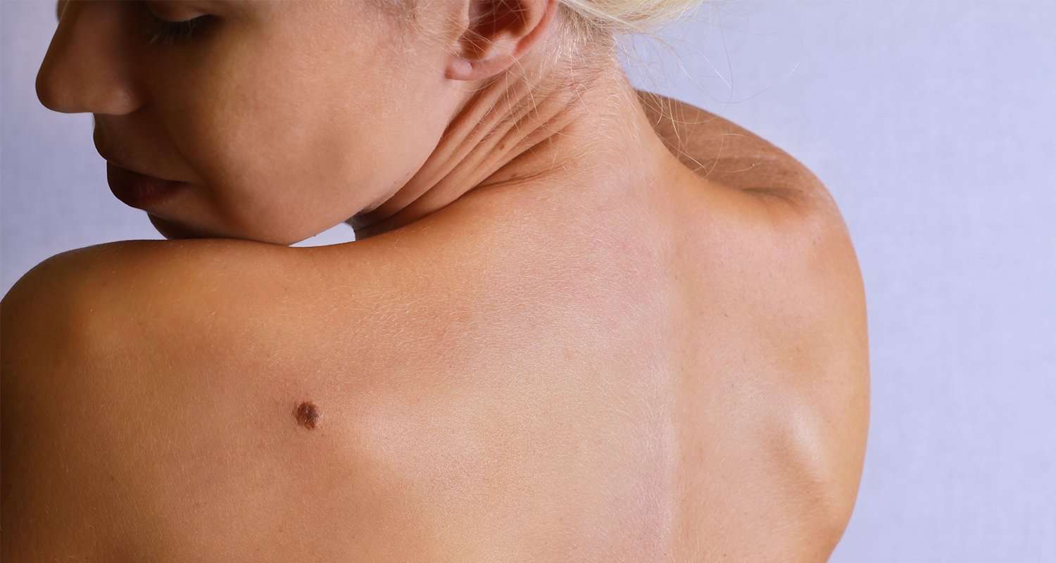 7 Skin Cancer Symptoms You Can