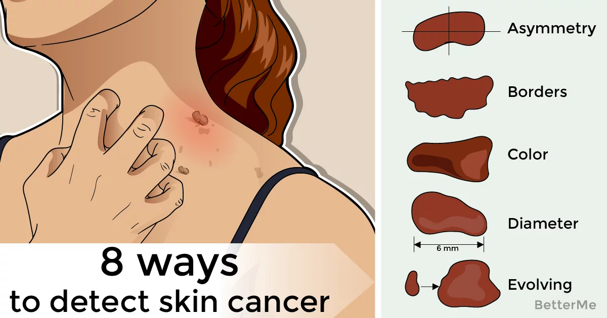 8 ways to detect skin cancer