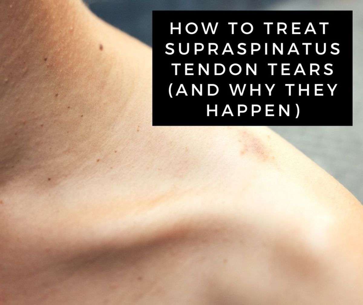 A Guide to Supraspinatus Tendon Tears (Rotator Cuff Injury ...