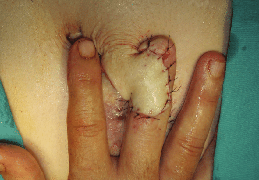 a) Preoperative photograph of a squamous cell carcinoma on ...