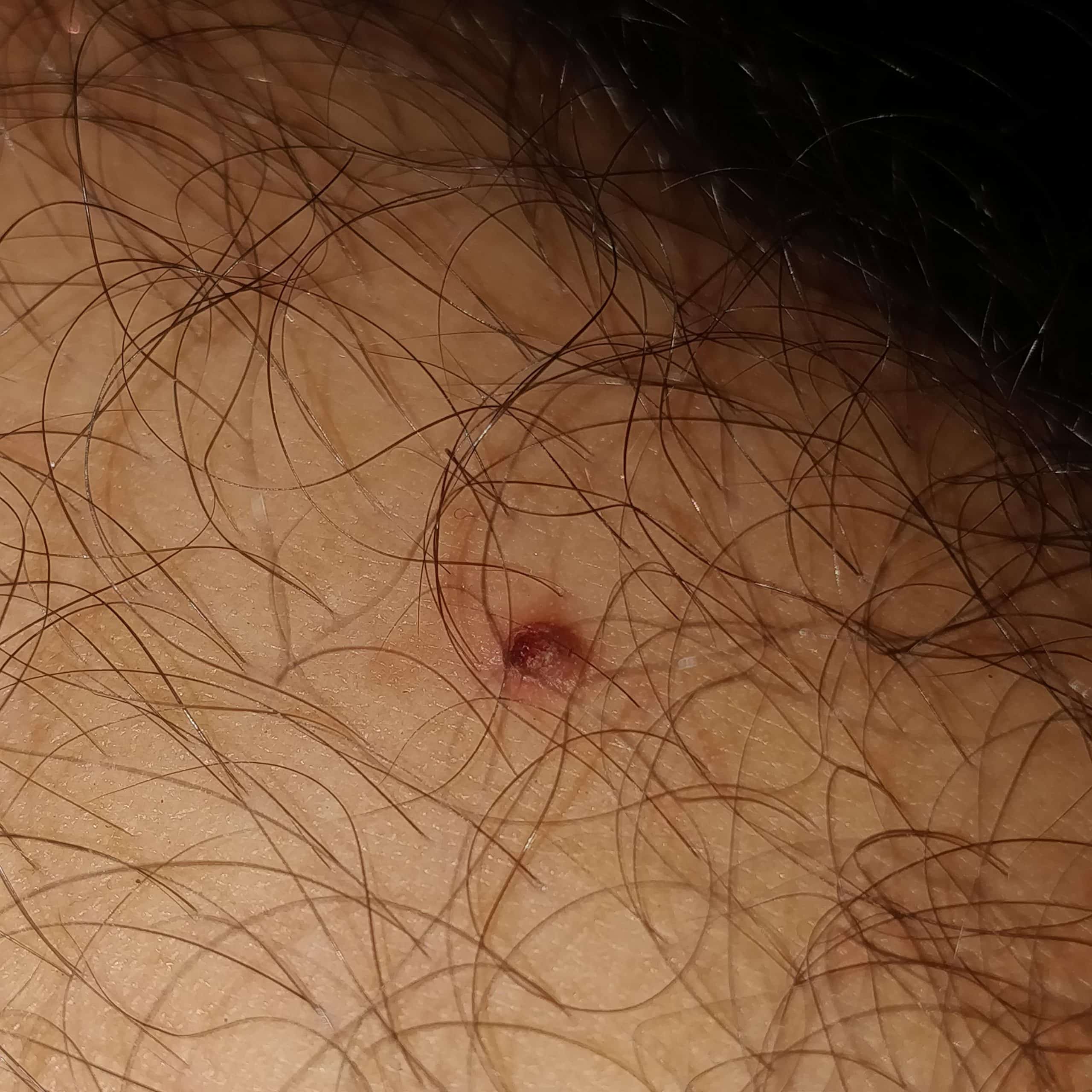 A small lump on my(20,M) right leg calf region, scared it might be ...