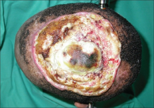 A top view of the aggressive squamous cell carcinoma of ...
