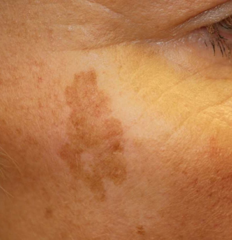 ã?ãã¹ãã³ã¬ã¯ã·ã§ã³ã age spots vs skin cancer pictures 200344
