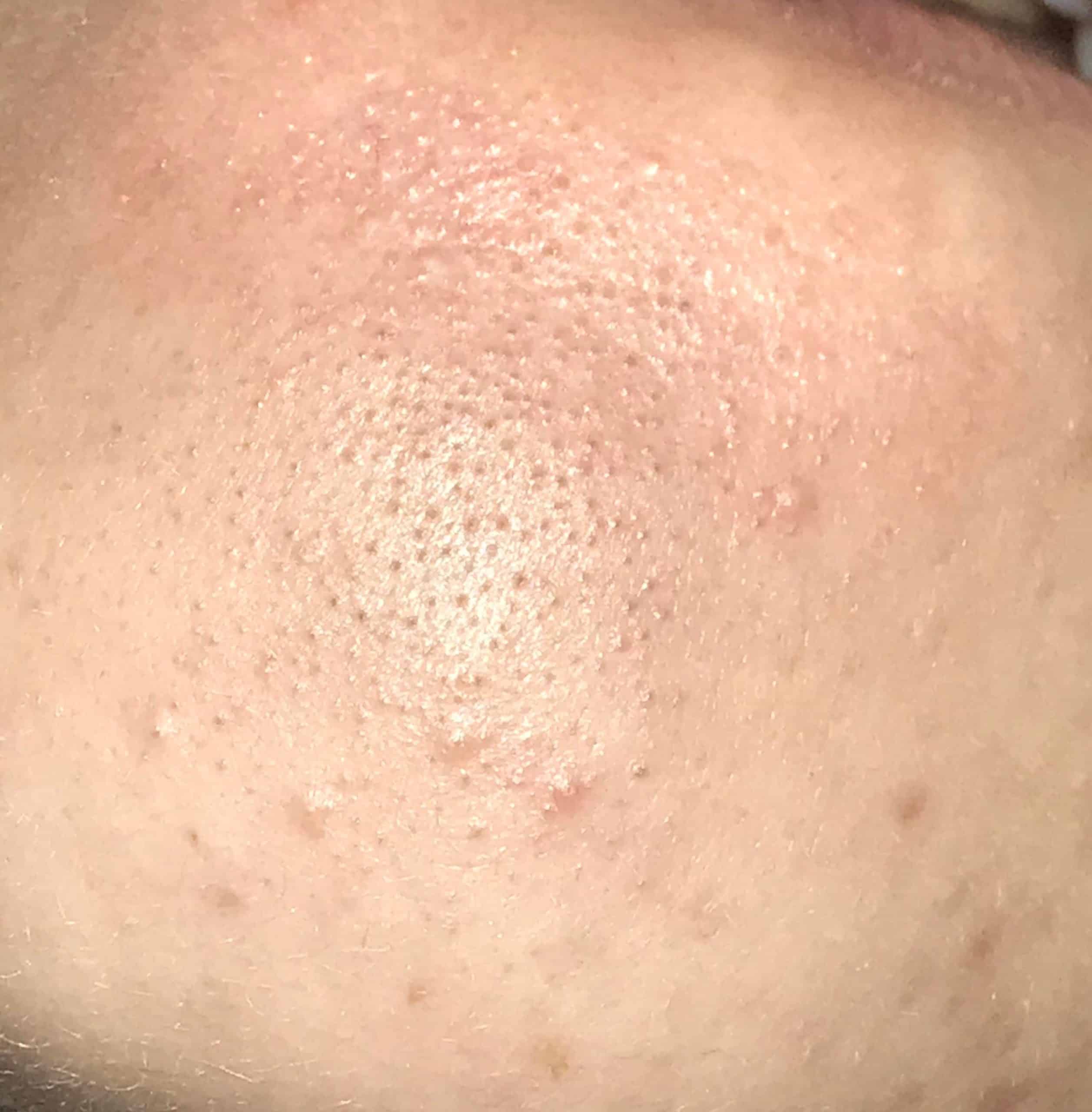 [acne] Can anyone suggest how to help clear this on my chin? Not sure ...