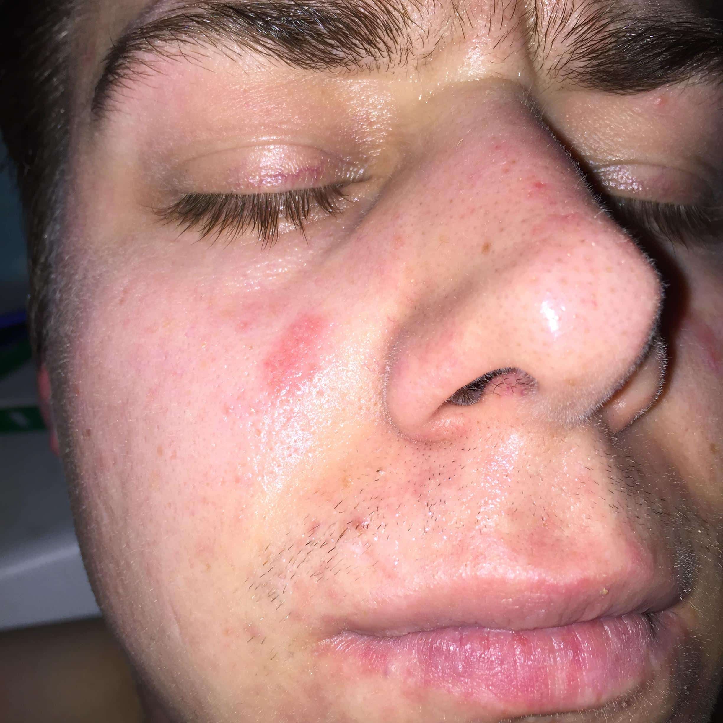 Acne like rash/spots