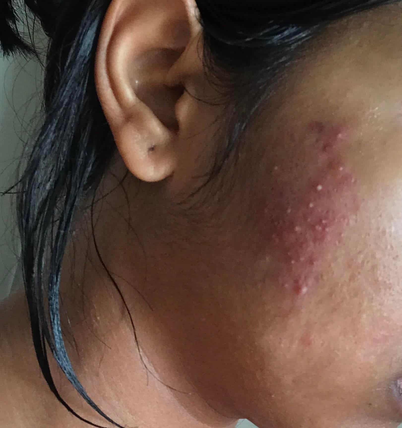 [Acne] My skin just broke out in this painful acne cluster and I have ...