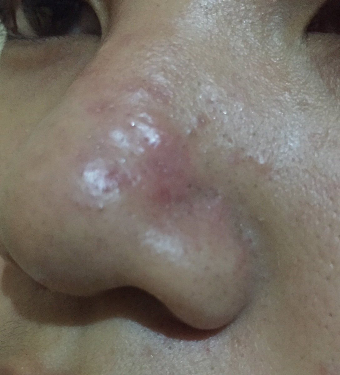 Acne scars and bumps on nose