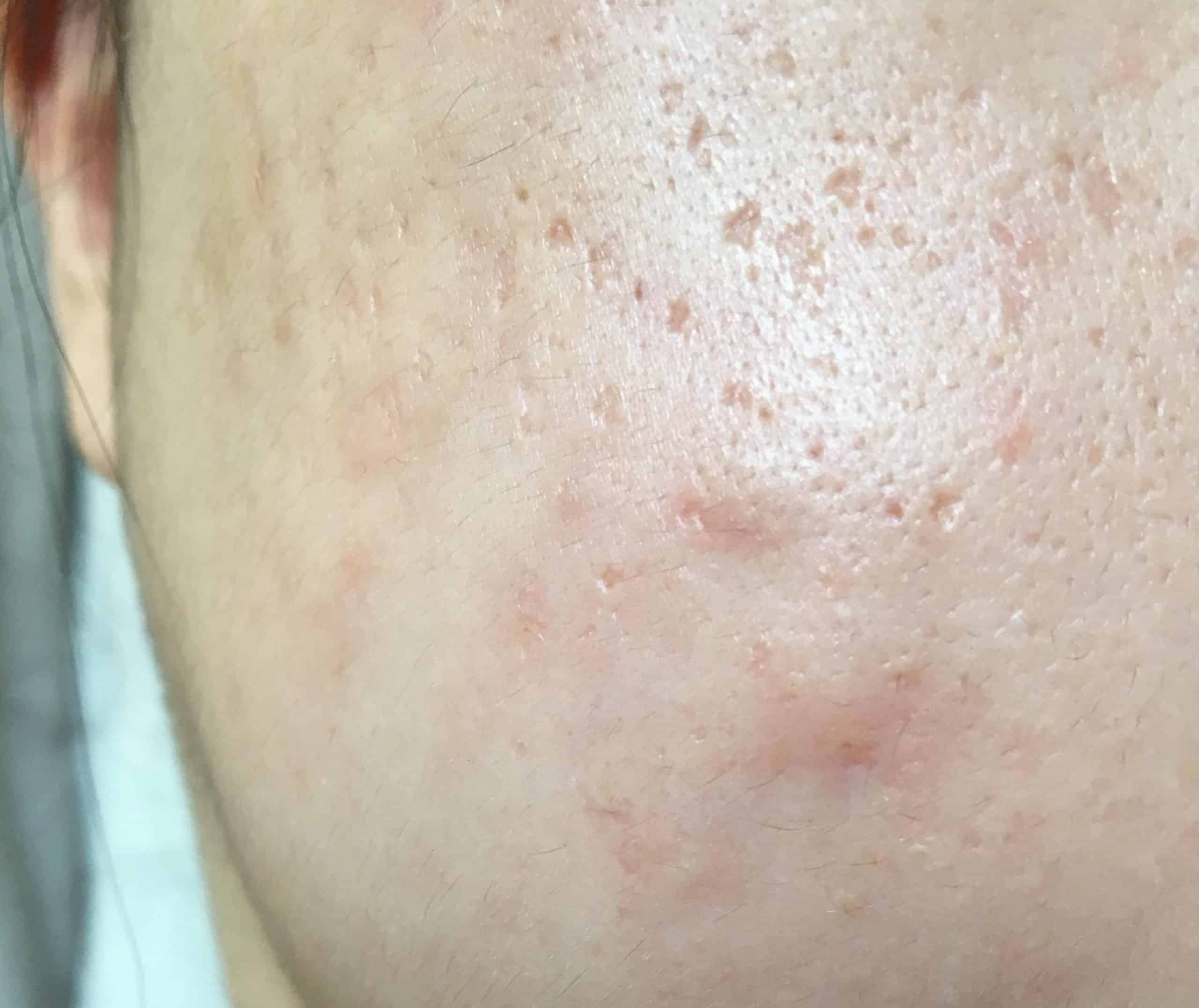 [acne] What to do about these huge under the skin bumps (Cyst? Nodule ...