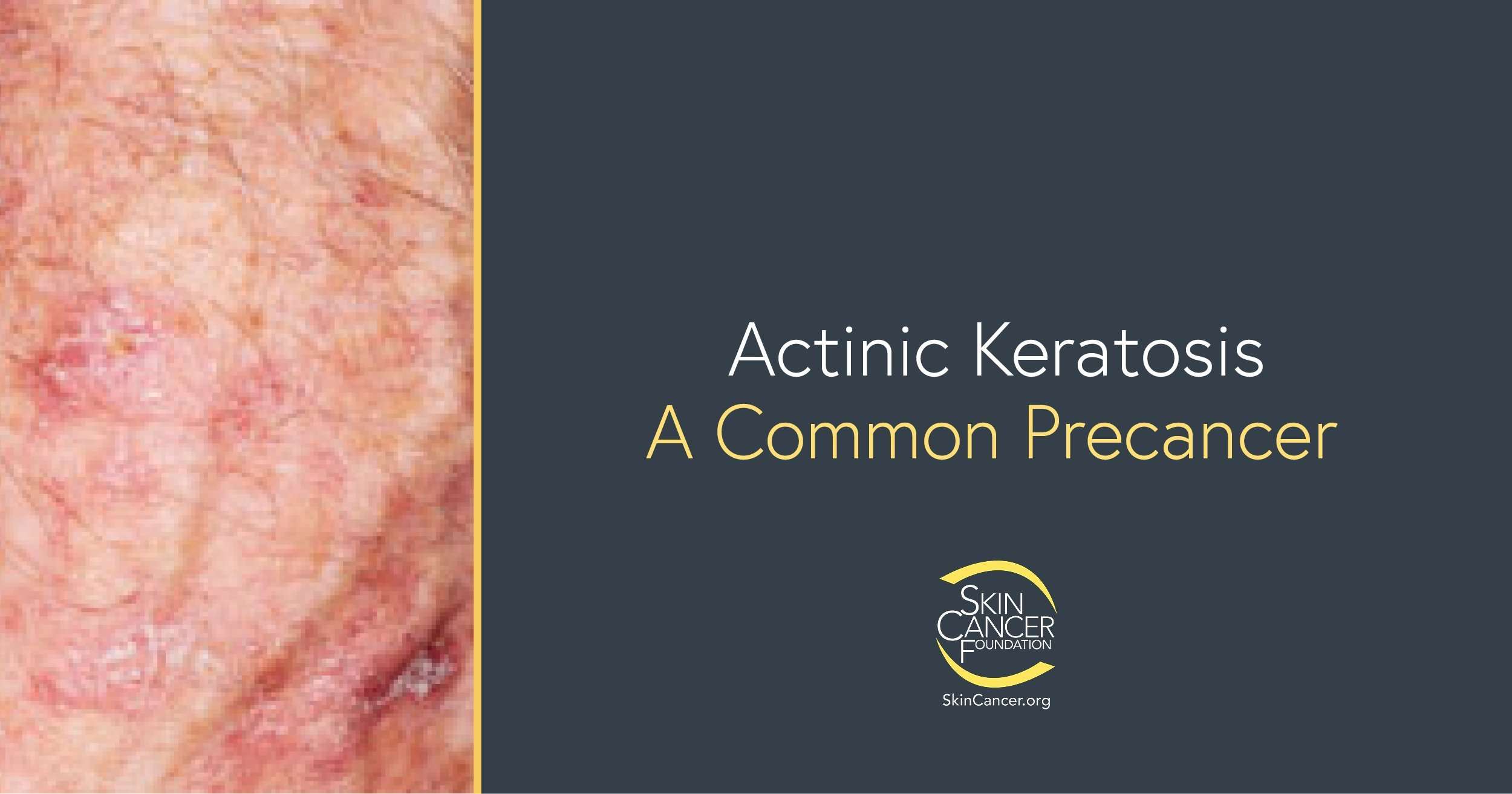 Actinic Keratosis Treatment