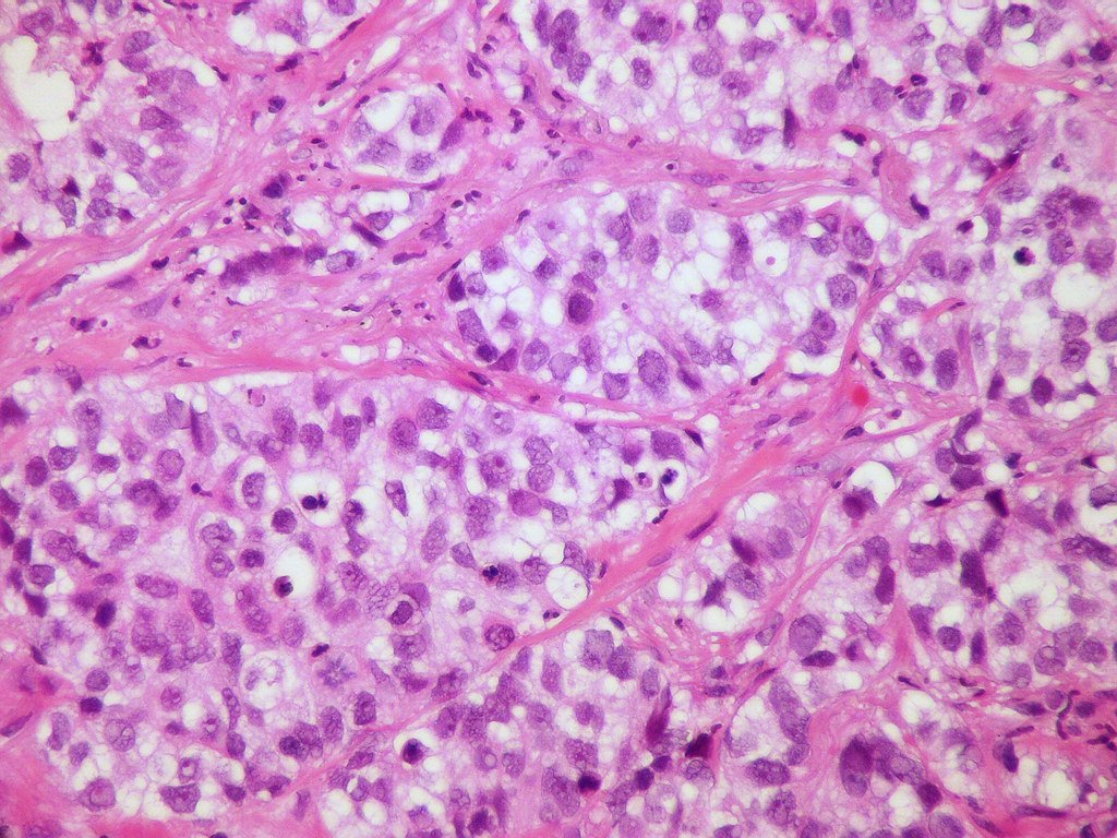 Adenocarcinoma with clear cells