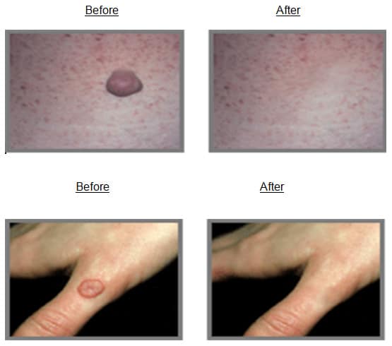 Aesthica Clinic Pattaya : Mole, Wart or Tumors