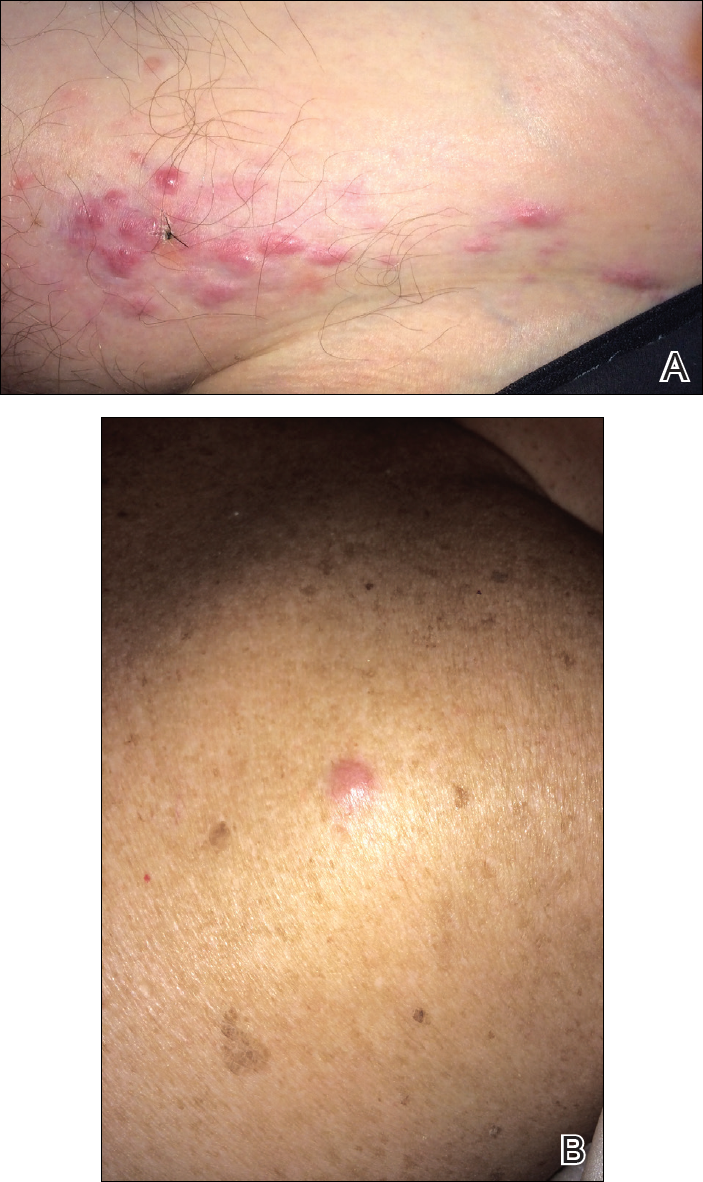 Aggressive Merkel Cell Carcinoma in a Liver Transplant ...