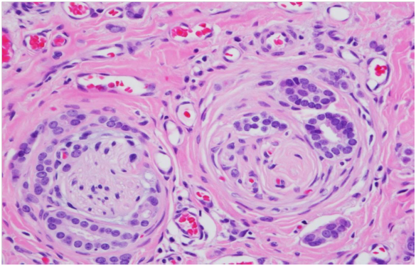 Aggressive well differentiated invasive ductal carcinoma ...