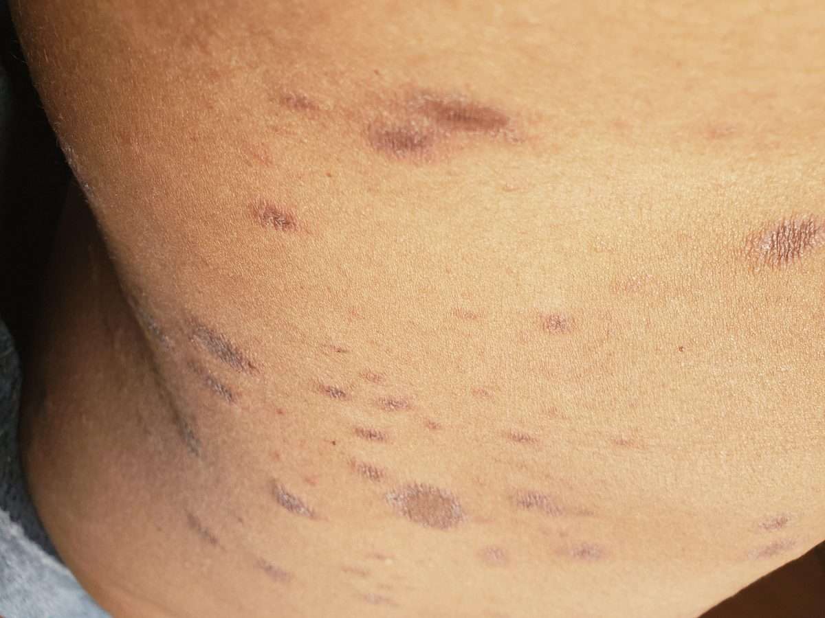 itchy-red-skin-bumps-on-body-images-and-photos-finder