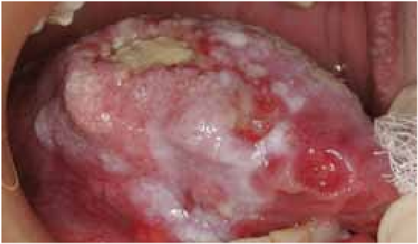 an extensive squamous cell carcinoma of the lateral