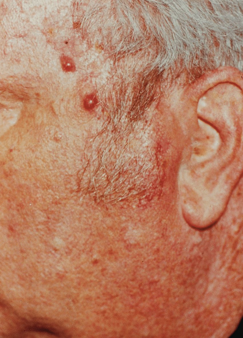 Appearance of skin lesions in a patient with Merkel cell ...