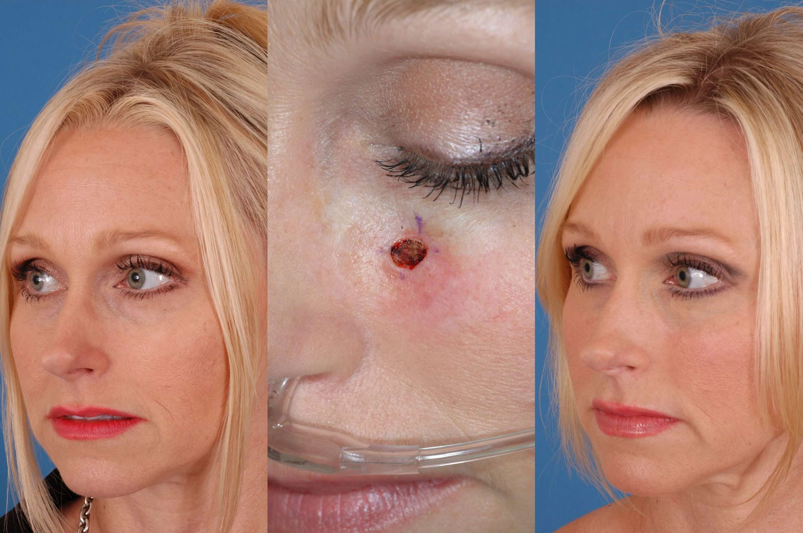 ar skin cancer reconstruction  Dallas Advanced Facial ...