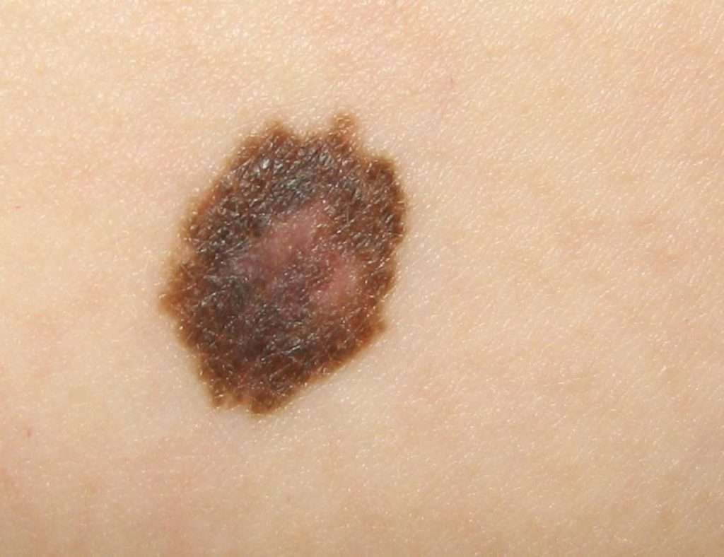 ARE SKIN CANCERS ITCHY?
