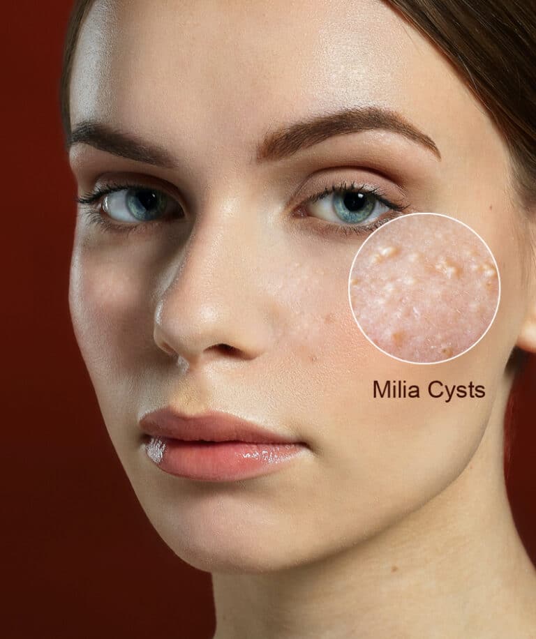 Are you embarrassed by your milia cysts? Here