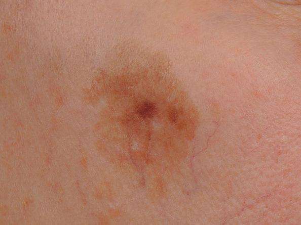 At risk for deadly skin cancer? Early detection key
