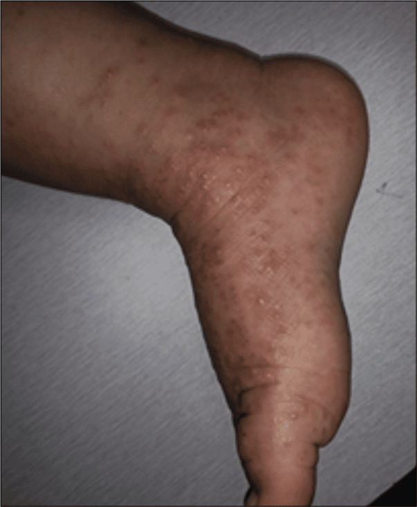 Atypical manifestations of atopic dermatitis