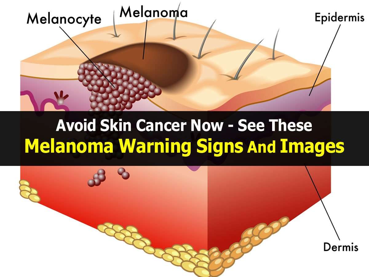 Avoid Skin Cancer Now