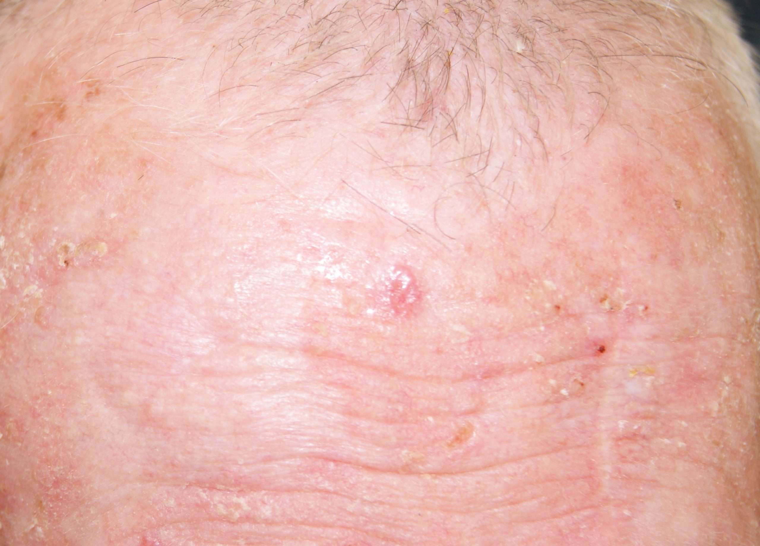 Basal Cell Cancer (BCC)  Skin Repair
