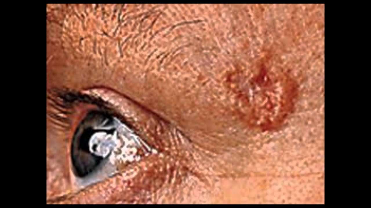 basal cell carcinoma : Basal Cell Carcinoma pictures ...