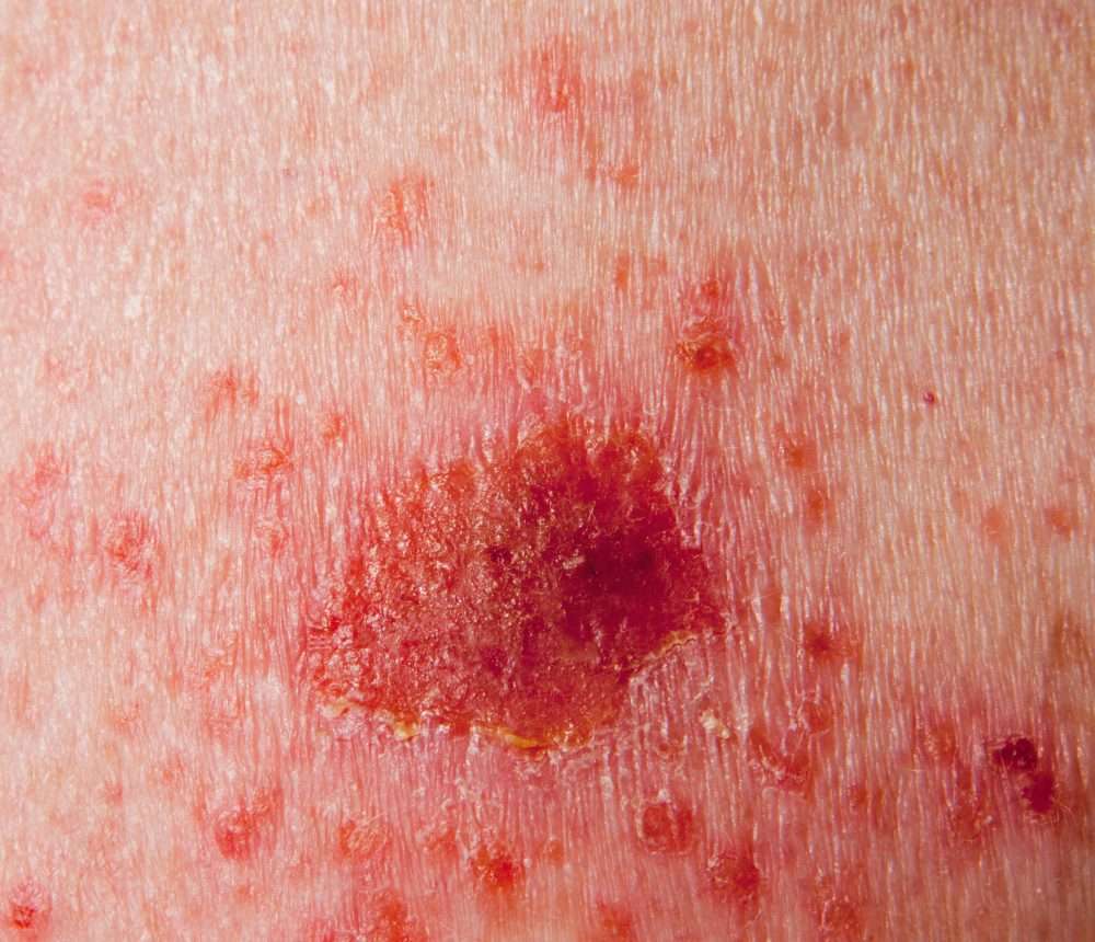 BASAL CELL CARCINOMA (BCC)  Skin Cancer Foundation
