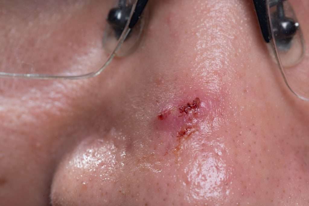 Basal Cell Carcinoma (BCC) Treatment
