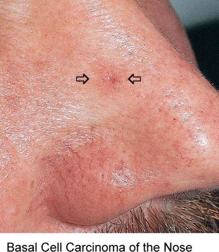 Basal Cell Carcinoma can be a tiny red flaky area that won ...