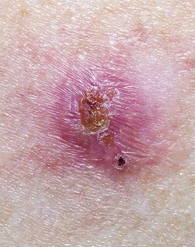 Basal Cell Carcinoma: Diagnosis and Treatment