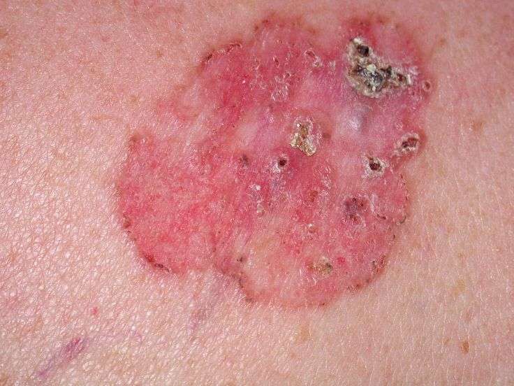 Basal cell carcinoma: dry red patch that doesn