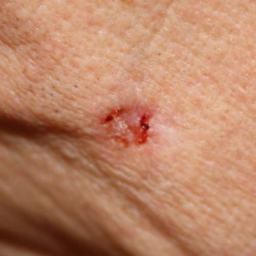 Basal Cell Carcinoma: Locations, Symptoms, and Pictures