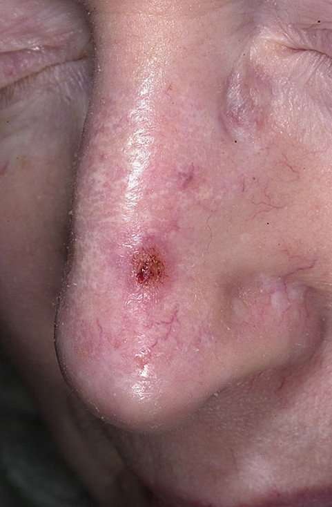 Basal Cell Carcinoma Nose Pictures â 54 Photos &  Images ...
